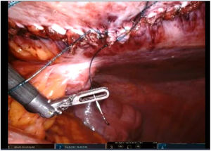 Cierre de la lámina posterior de la vaina del recto izquierdo.