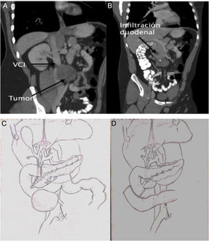 A y B) Imagen de la tomografía axial en cortes coronales de la lesión quística infiltrando duodeno y grandes vasos. C) Imagen de la situación del tumor con respecto a la papila. D) Imagen de la reconstrucción digestiva tras resección duodenal.