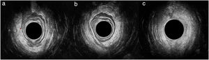 Ecografía endoanal para estudio del prolapso: a) canal anal alto, asimetría entre ramas derecha e izquierda del músculo puborrectal; b) canal anal medio, adelgazamiento de esfínter anal externo en cuadrantes izquierdos; c) canal anal bajo sin alteraciones.