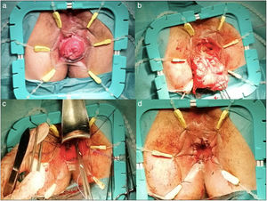 Reparación del prolapso anal según el procedimiento de Altemeier: a) prolapso previo a la cirugía; b) resección de la plastia; c) levatorplastia; d) aspecto final.