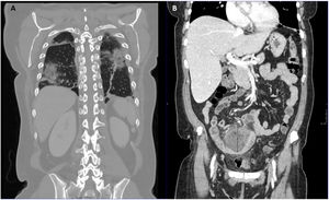 Cortes coronales de TAC toracoabdominal donde se observa A) afectación pulmonar bilateral compatible con COVID-19 y B) plastrón apendicular en fosa iliaca derecha.