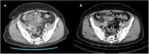 Corte axial de TAC abdominal donde se evidencia A) el plastrón apendicular al diagnóstico y b) la práctica resolución del mismo a los 9 días de la TAC previa.
