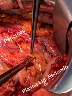 Plastia de ligamento redondo sobre borde de sección pancreático tras colocación de stent.