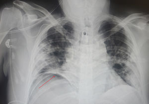 Radiografía torácica de control tras desconexión de ventilación mecánica. Se objetiva neumoperitoneo subfrénico derecho. Consolidaciones neumónicas bilaterales como consecuencia de neumonía por COVID-19.