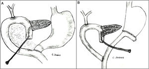 Técnicas de reconstrucción post-DPC con tutorización externa del Wirsung. A) Duodeno-yeyunostomía término-lateral en preservación pilórica. B) Gastro-yeyunostomía término-lateral y yeyuno-yeyunostomía término-lateral a pie de asa (en Y) en antrectomía.