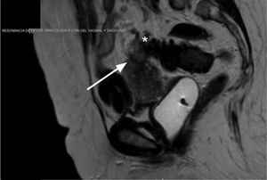 Corte sagital de resonancia magnética en secuencias T2 con gel endovaginal. Se observa colección heterogénea con relación a la pared anterior del colon sigmoides (*) en contacto con el fondo uterino y fístula lineal hiperintensa (blanco) que atraviesa el miometrio (flecha).