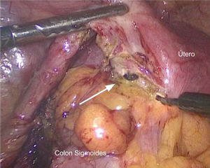 Puede observarse la fístula colouterina señalada por la flecha, hacia abajo el colon sigmoides adherido hacia al útero que está siendo disecado con electrocauterio.