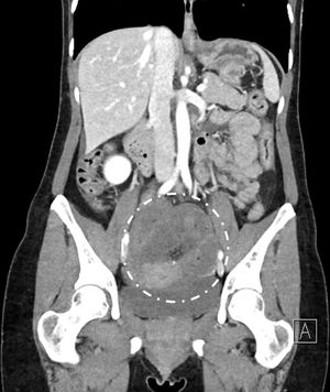Tomografía computarizada: imagen de la obstrucción intestinal con sufrimiento del asa de intestino delgado.