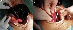 a) Asa de intestino delgado necrótica. b)Defecto del ligamento ancho (tipo ventana según Hunt, tipo3 según Cilley).