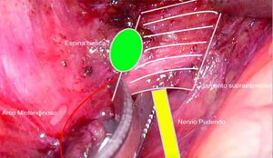 Sección del ligamento sacroespinoso.