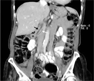TC abdominal: lesión de unos 17mm (asterisco) localizada en el área periampular. Mínima ectasia del colédoco (flecha negra) y del conducto de Wirsung (flecha blanca).