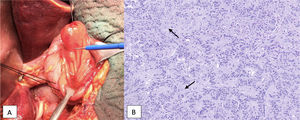 Paraganglioma gangliocítico yuxtapapilar. A: aspecto macroscópico. B: aspecto microscópico. Tinción con hematoxilina-eosina. Muestra células neuroendocrinas (nidos de células alargadas que forman cordones o estructuras pseudoglandulares, en empalizada), células con diferenciación a células de Schwann y células ganglionares (más grandes, de citoplasma amplio, núcleo grande y vesiculoso; marcadas con una flecha).