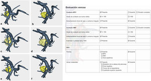 Estudio venoso extraído del modelo tridimensional e información aportada por el modelo. Permite visualizar en 360° la relación del tumor con la VMS, vena esplénica, vena porta y sus ramas colaterales.
