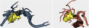 Relación entre la zona de contacto del tumor con las estructuras vasculares. a. VMS: se observa el tumor dentro de la luz del vaso b. AMS: se observa contacto con el tumor, pero no infiltración.