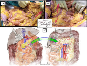 Acceso aórtico inframesocólico longitudinal. A y B) Demostración en cadáver en fresco. Las flechas rojas indican la dirección de tracción del colon transverso, paquete intestinal y sigma para conseguir la exposición correcta de la aorta infrarrenal. 1: ángulo duodenoyeyunal; 2: aorta. C) La línea discontinua roja indica la liberación del ángulo de Treitz para lograr una exposición correcta. Se muestran las estructuras anatómicas expuestas tras la apertura del retroperitoneo preaórtico. 3: vena renal izquierda; 4: arteria mesentérica inferior. El color de la figura solo puede apreciarse en la versión electrónica.