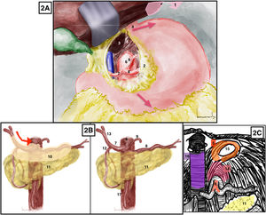A) Abordaje aórtico supracelíaco. Las flechas rojas marcan la dirección de tracción esofagogástrica. B) Abordaje tronco celíaco. Flecha roja: dirección de apertura del peritoneo que cubre estructuras vasculares. C) Abordaje del tronco celíaco, identificación del ligamento arcuato. 1: ligamento triangular hepático izquierdo; 2: epiplón menor o ligamento gastrohepático; 3: lóbulo caudado hepático; 4: unión gastroesofágica; 5: pilares diafragmáticos; 6: tronco celíaco; 7: arteria hepática común; 8: arteria esplénica; 9: arteria gástrica izquierda; 10: peritoneo que recubre estructuras vasculares; 11: páncreas; 12: arteria gastroduodenal; 13: arteria hepática propia; 14: ligamento arcuato; 15: hiato esofágico; 16: vena cava; 17: arteria mesentérica superior. El color de la figura solo puede apreciarse en la versión electrónica.