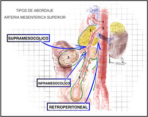 Tipos de abordaje de la arteria mesentérica superior. Supramesocólico, inframesocólico y retroperitoneal. 1: arteria mesentérica superior; 2: páncreas; 3: vena renal izquierda; 4: duodeno; 5: colon transverso; 6: mesenterio.