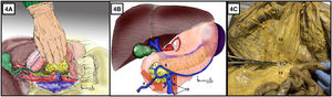 A) Abordaje retroperitoneal tras tracción duodeno-pancreática hacia el hombro izquierdo del paciente. B) Identificación del tronco gastrocólico de Henle mediante abordaje supramesocólico de la arteria mesentérica superior. La flecha roja indica la dirección de la disección para el abordaje de la arteria mesentérica superior. C) Simulación en cadáver formolizado de abordaje inframesocólico, tracción superior del colon transverso y tracción inferior de primera asa yeyunal. 1: arteria mesentérica superior; 2: vena mesentérica superior; 3: vena renal izquierda; 4: aorta; 5: vena cava; 6: vena gastroepiploica derecha; 7: vena pancreatoduodenal anterosuperior; 8: vena cólica derecha superior; 9: vena cólica media; 10: venas yeyunales; 11: colon transverso; 12: mesocolon; 13: mesenterio; 14: primera asa yeyunal. El color de la figura solo puede apreciarse en la versión electrónica.