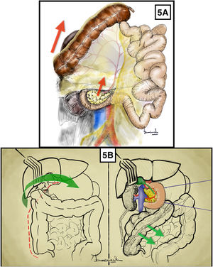 Maniobra de Cattell-Braasch. A) Liberación de colon y duodeno a través del plano embriológico de la fascia de coalescencia de Toldt. Las flechas rojas indican el sentido de la tracción del colon derecho, duodeno y páncreas. B) Liberación del ángulo hepático primero y maniobra de Kocher posteriormente. Las flechas verdes indican la dirección de tracción del ángulo hepático del colon. El color de la figura solo puede apreciarse en la versión electrónica.