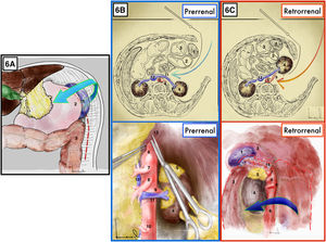 Maniobra de Mattox. A) Comienza por la decolación izquierda y liberación esplénica de sus adherencias al peritoneo parietal. B) Mattox Prerrenal. C) Mattox retrorrenal. 1: bazo; 2: estómago; 3: bazo; 4: riñón izquierdo; 5: glándula suprarrenal izquierda; 6: aorta; 7: tronco celíaco; 8: arteria mesentérica superior; 9: arteria renal izquierda; 10: arteria mesentérica inferior; 11: vena renal izquierda; 12: vena cava; 13: pilares diafragmáticos; 14: arteria esplénica.