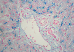 Biopsia hepática: gran cantidad de hierro acumulado en los hepatocitos consecuencia del tratamiento con hemina (coloración azul de Prusia en tinción de Perl). El color de la figura solo puede apreciarse en la versión electrónica del artículo.