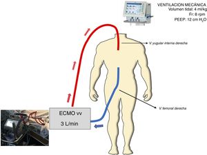 Esquema del dispositivo ECMO-vv empleado. ECMO-vv: oxigenación con membrana extracorpórea; PEEP: presión positiva al final de la espiración; Fr: frecuencia respiratoria.