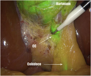 Disección posterior al triángulo de Calot y lateral de la vesícula biliar. CC: conducto cístico.