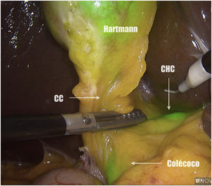 Identificación del CHC y del colédoco.CC: conducto cístico; CHC: conducto hepático común.