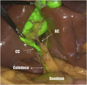 Visión crítica de seguridad.AC: arteria cística; CC: conducto cístico.
