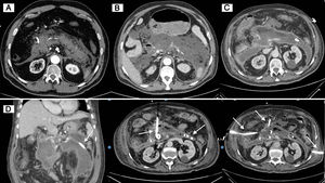 A: TAC abdominal al ingreso. B: TAC abdominal a los 15 días del ingreso. C: TAC abdominal a los 29 días del ingreso. D: Tres drenajes percutáneos colocados mediante TAC abdominal de forma sucesiva para drenaje de colección (señalados con flechas).