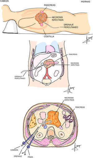 Imagen esquemática de la necrosectomía retroperitoneal videoasistida por el lado derecho.