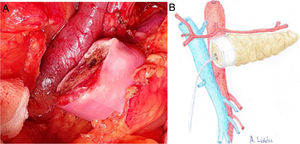 a) Imagen intraoperatoria de la disposición final de la malla biológica en el remanente pancreático. b) Dibujo representativo de la fig. 2a.