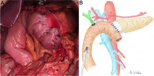 a) Imagen intraoperatoria tras finalizar REDMA. b) Dibujo representativo de la fig. 3a.