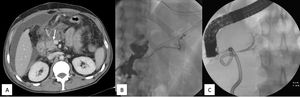 A) TC abdominal con contraste intravenoso. Colección periduodenal y líquido libre intraabdominal. La flecha muestra el cuello pancreático, lugar más probable donde se produjo la lesión. B) Fistulografía. Se rellena la colección y el conducto de Wirsung distal (páncreas dorsal). C) CPRE. Opacificación del conducto pancreático correspondiente al páncreas ventral sin comunicación con el páncreas dorsal. No existe extravasación de contraste.