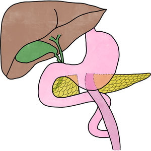 Esquema de la cirugía realizada: sección del cuello pancreático, sutura del páncreas proximal y realización de pancreaticoyeyunostomía término-lateral ductomucosa en Y de Roux.