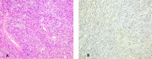 A. Proliferación mesenquimal que se dispone en haces y fascículos con presencia de colágeno hialinizado y estructuras vasculares ramificadas (hematoxilina eosina, 100x); B. La celularidad neoplásica muestra intensa positividad para CD34.