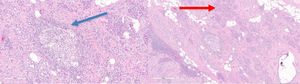 Tinciones hematoxilina-eosina 40x y 100x de proceso granulomatoso no necrotizante – histiocitos y linfocitos - (flecha azul) en tejido pancreático – acinos - (flecha roja), bacilos ácido-alcohol resistentes negativos.