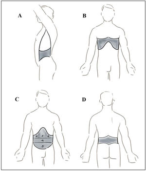 Regiones abdominales consideradas. A: Flancos; B: Toracoabdominal; C: Abdomen anterior (1. Epigastrio; 2. Hipocondrio derecho; 3. Hipocondrio izquierdo; 4. Mesogastrio; 5. Hipogastrio); D: Lumbar.