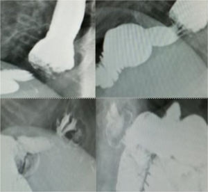Tránsito esofagogástrico en el que se evidencia hernia de hiato.