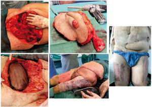 Imágenes de la exéresis y reconstrucción (A-D). Resultado al mes de la cirugía (E).