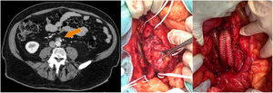 A la izquierda: TC con hallazgo de lesión retroperitoneal sospechosa de recidiva neoplásica. A la derecha: imágenes intraoperatorias, en las cuales se pueden observar la aorta, la vena cava inferior, las arterias ilíacas, el uréter izquierdo y el bypass aortoilíaco realizado con prótesis de Dacron®.