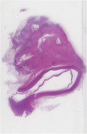 Foto panorámica donde se observa pared de la aorta con infiltración por adenocarcinoma.