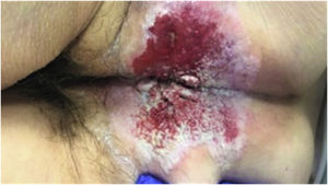 Extramammary perianal Paget