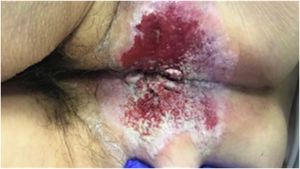 Extramammary perianal Paget's disease: clinical presentation of perianal cutaneous lesions. Caption: large erythematous, exfoliative, enrolled plaque located in the perianal region with anterior extension proximal to the vaginal introit in a 71 years old woman.