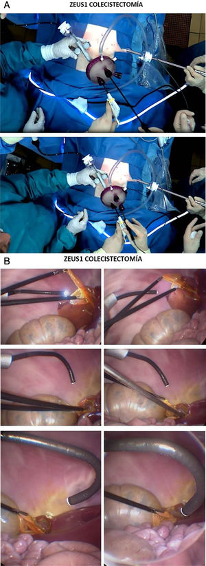 A) Campo quirúrgico durante colicestectomía con ZEUS1. B) Colecistectomía: visión intracavitaria.