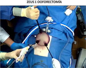 Campo quirúrgico durante ooforectomía con ZEUS1.