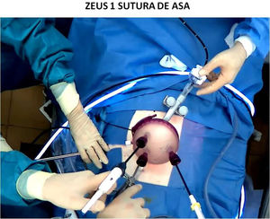 Campo quirúrgico durante sutura de asa con ZEUS1.