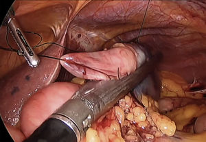 Resección en cuña laparoscópica asistida por endoscopia (RCAE).