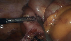 Resección en cuña laparoscópica asistida por endoscopia (RCAE) en el ciego.