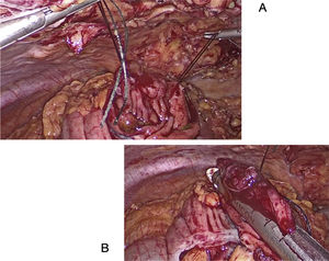Resección transluminal laparoscópica asistida por endoscopia (RTLE). A) Colotomía y exteriorización de la lesión tras puntos de tracción laparoscópicos. B) Sección mecánica del tumor.